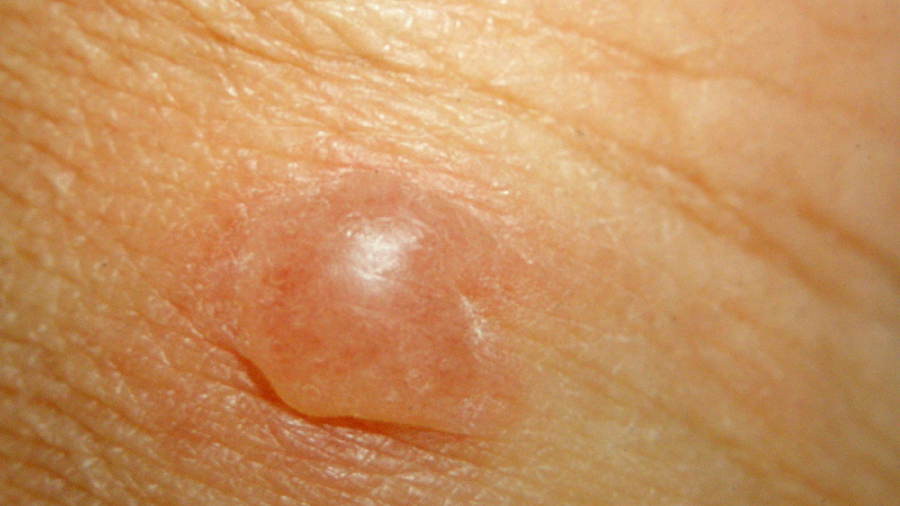skin bumps